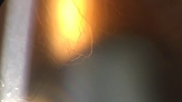 Globules rouges circulant dans des néovaisseaux cornéens