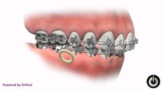Class II elastics right side