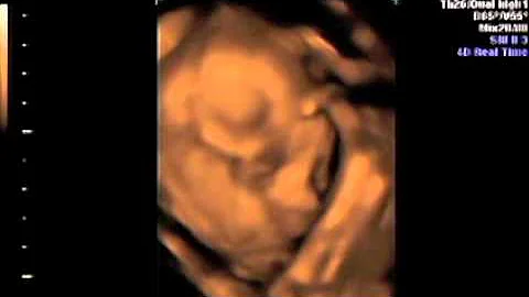 4-d Ultrasound of Leonard Thomas Maness