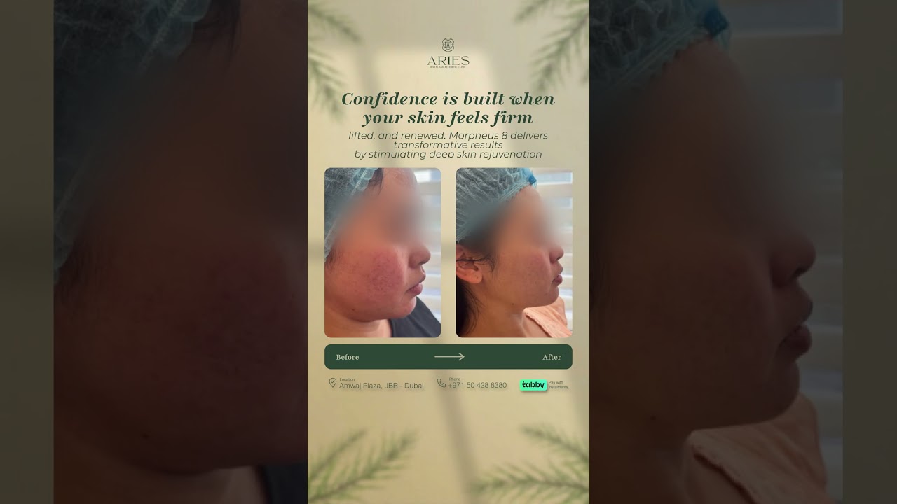 Lift. Renew. Transform. See the results Morpheus8 can deliver video thumbnail