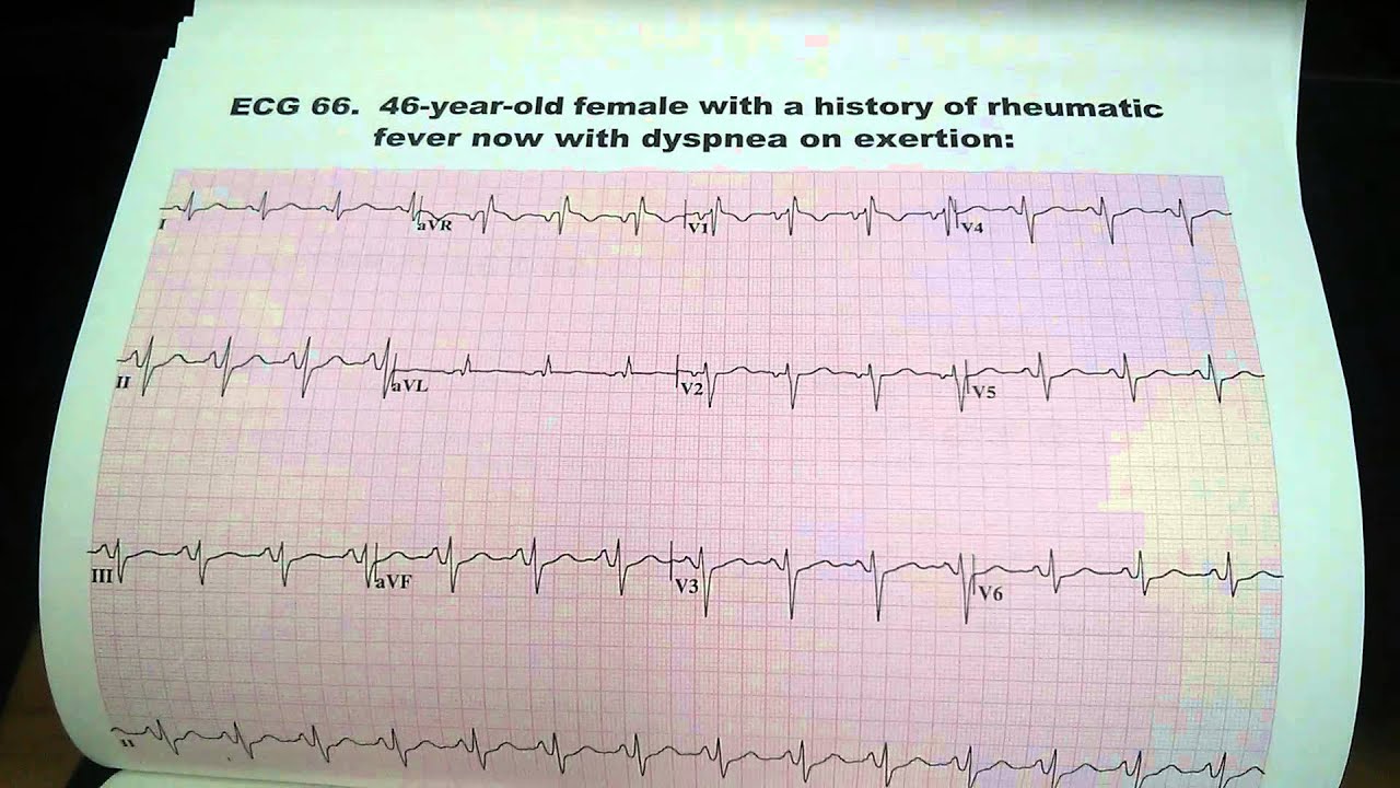 Rheumatic Fever Dyspnea Uri Ben Zur MD EKG ECG Electrocardiogram YouTube rheumatic-fever-dyspnea-uri-ben-zur-md-ekg-ecg-electrocardiogram-youtube