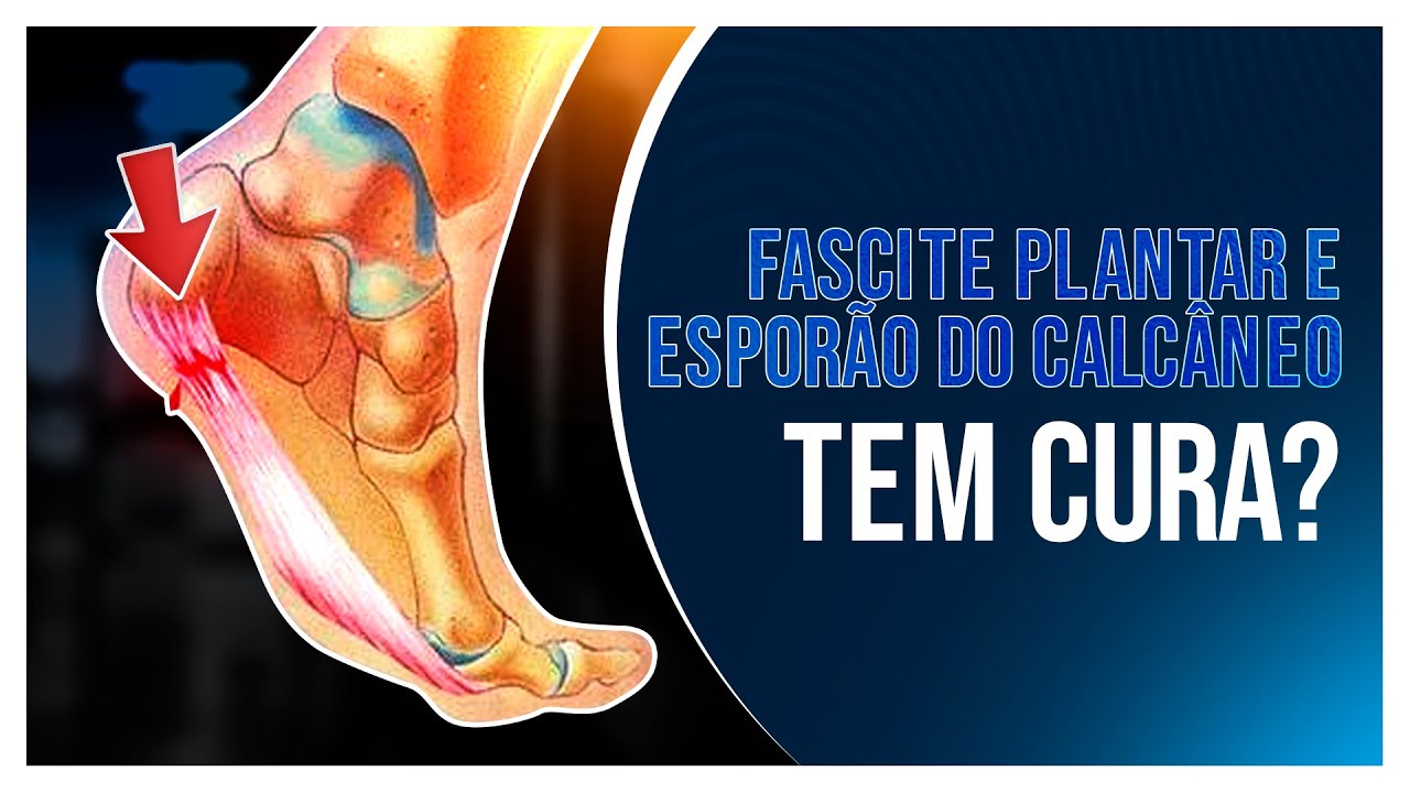 Esporão Do Calcanhar: O Que É E Como Tratar? – GRKCZ