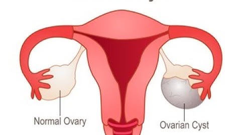 Drainage of ovarian cyst CPT code - simplify medical coding