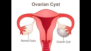 Drainage of ovarian cyst CPT code - simplify medical coding