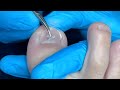 Paciente corta mal su uña y ve lo qué pasa😰 #podologo #nails #satisfying