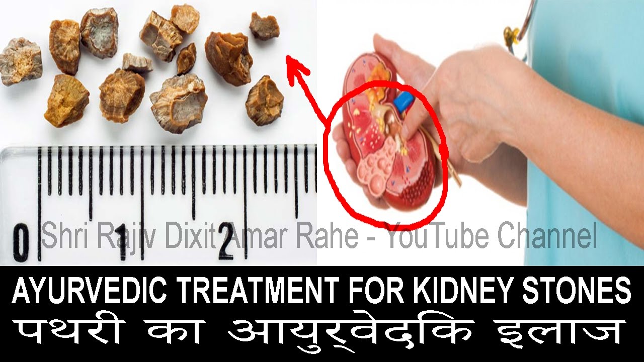 MUST WATCH! Ayurvedic Treatment For Kidney Stones (PATHRI) • पथरी का
