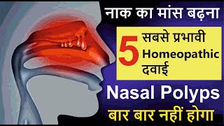 नाक की गांठ, मांस | Nasal Polyps Treatment Without Surgery | Nasal polyps homeopathic medicine