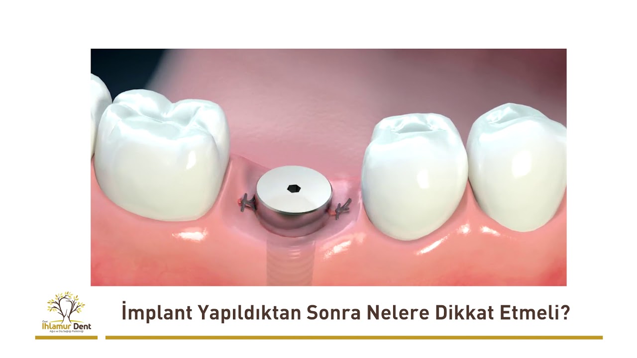 Dental İmplant Yapıldıktan Sonra Nelere Dikkat Etmeli?