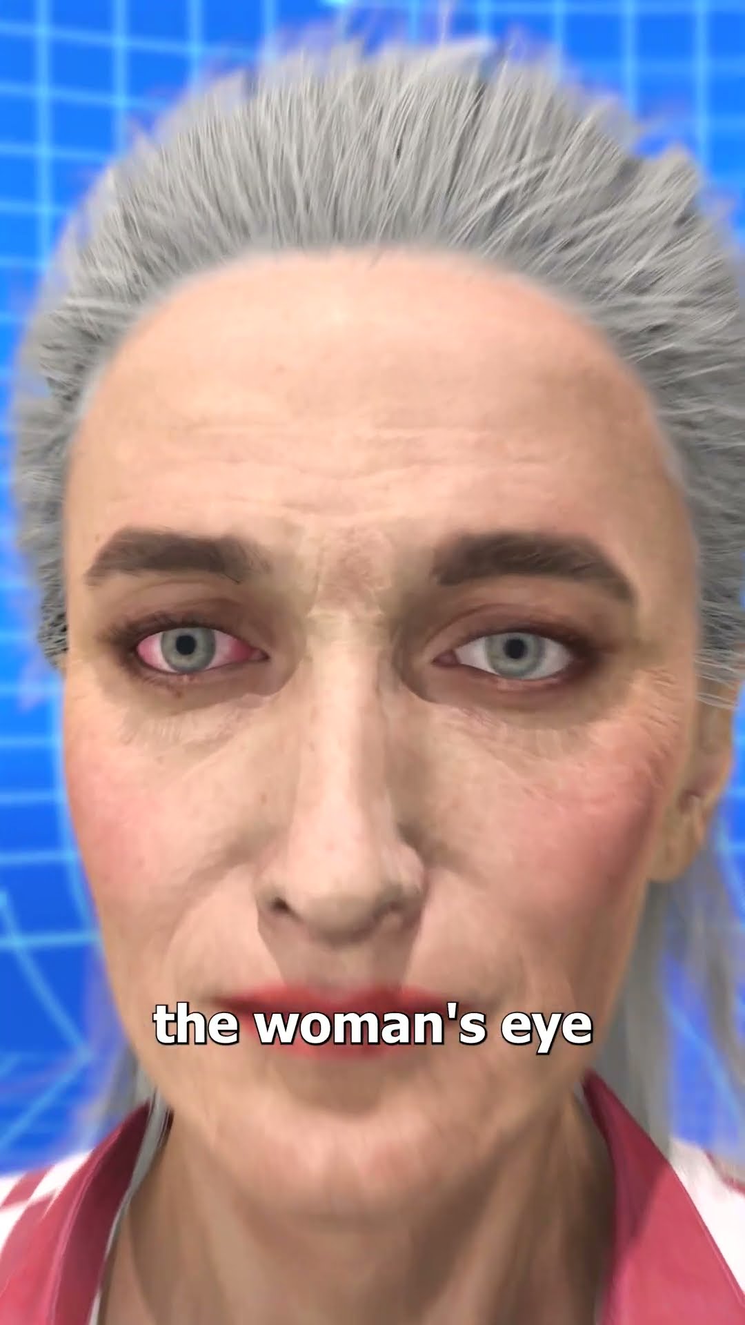 23 Contacts Stuck In Her Eye ?