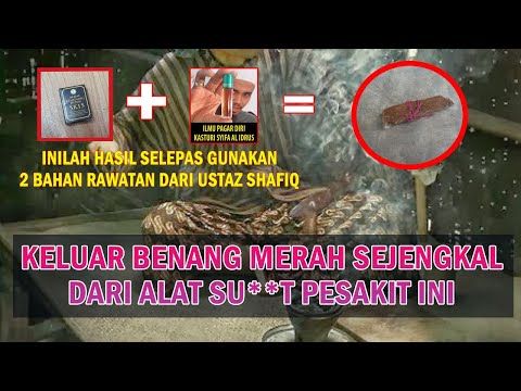 Mengejutkan, SEJENGKAL BENANG Keluar Dari KEMA**N Pesakit Ini