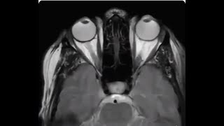 Eye movement during MRI.