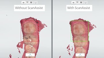 TRIOS 5 and the ultimate TRIOS scan engine: ScanAssist