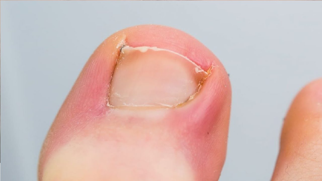 how to get rid of a infected ingrown toenail without surgery fast and