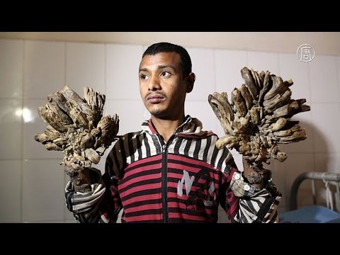 «Человек-дерево» из Бангладеш перенёс операцию (новости)