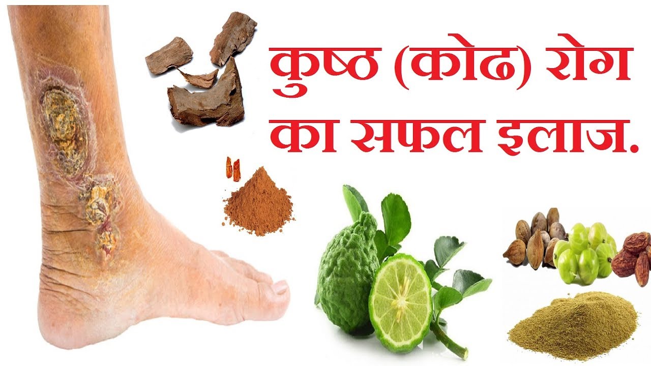 Home Remedies For Leprosy...कुष्ष्ठ (कोढ) रोग का सफल इलाज... JMD YouTube