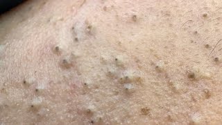 Rika Morning & Nighttime Cleansing Routine For Clear, Acne-Free Skin