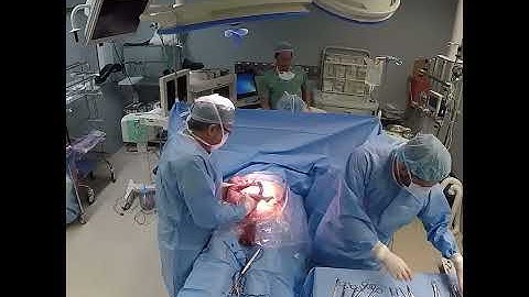 PAI DESMAIA DURANTE O NASCIMENTO - Vídeo de Parto Cesárea com cenas da placenta