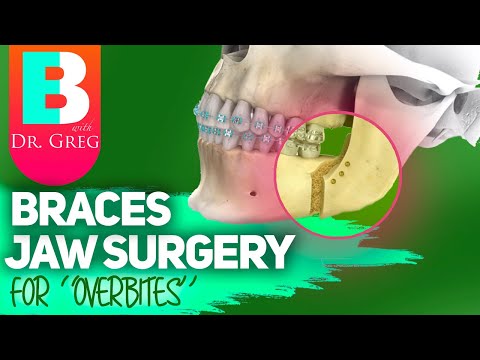 Braces Jaw Surgery for Overbite Correction (Overjet Correction)