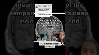 Mesial temporal epilepsy