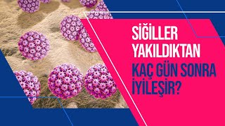 Siğil Yaktırma Nedir? Siğil Yaktırma Nasıl Yapılır? Her Siğil Yakılır Mı?