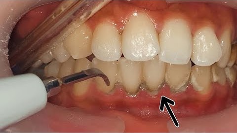 Karang Gigi Pada Gigi Depan | Dentist | Dokter Gigi Tri Putra