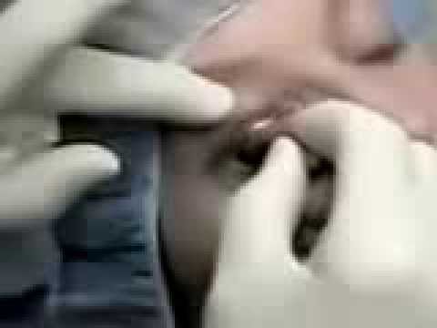 Блефаропластика с лазерной шлифовкой Sciton Contour TRL