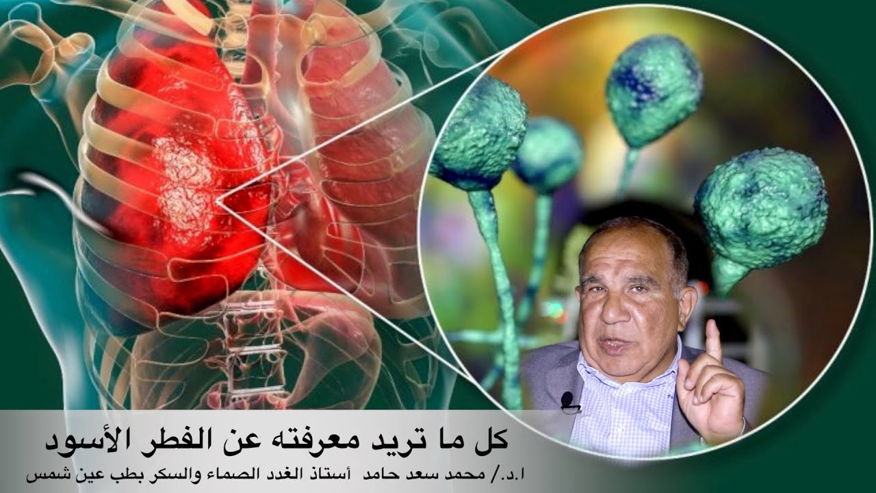 متى يصاب مريض كورونا بالفطر الأسود ؟