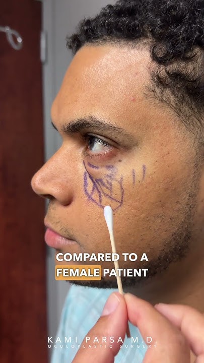 Lower Eye Bag Removal For Males With Dr Kami Parsa Trifecta Lift lower-eye-bag-removal-for-males-with-dr-kami-parsa-trifecta-lift