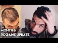 6 Month Rogaine Results (Minoxidil)