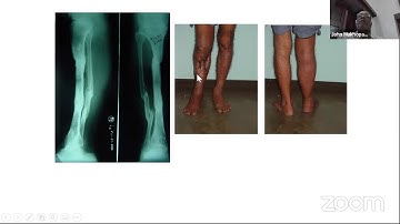 OREF India - Principles of Bone Transport Using Ilizarov Method- Tips and Techniques by Dr John M