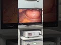 Laparoscopy Application - Laparoscopic Management of Cholecystectomy- 9007 Endoscopic Tower System