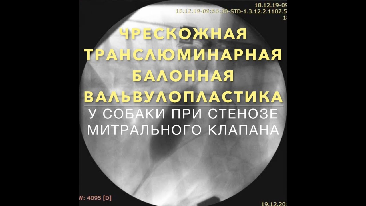 Баллонная вальвулопластика митрального клапана