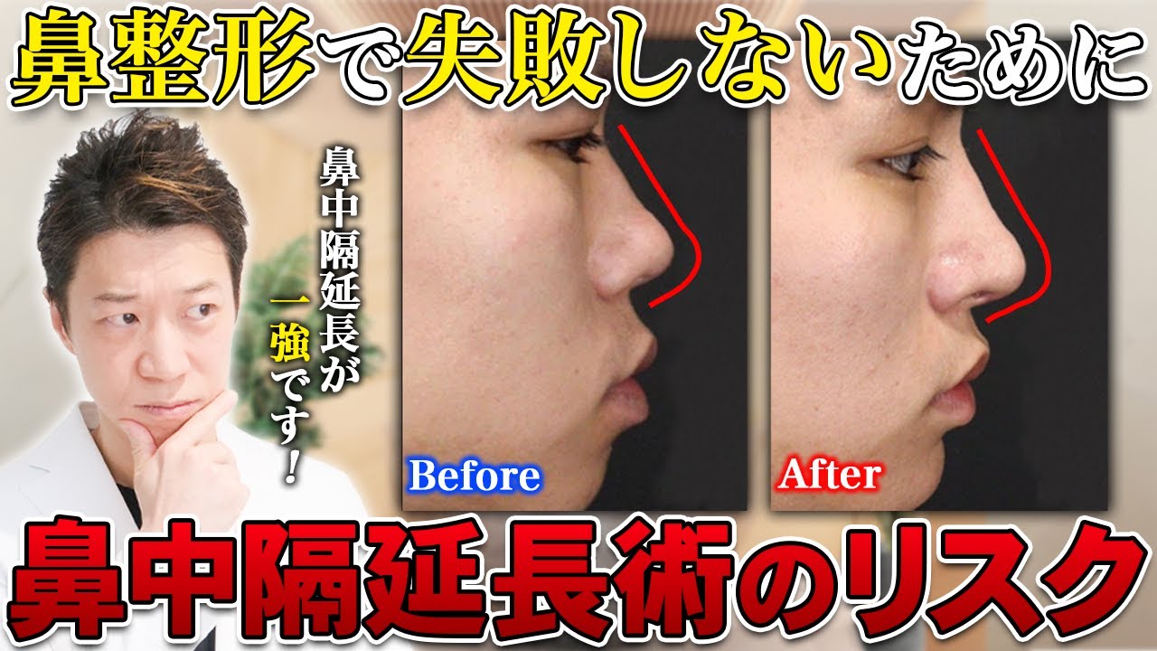 Rhinoplasty] What are the disadvantages of nasal septum extension