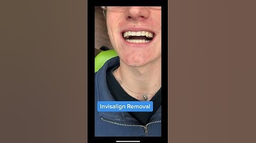 Invisalign Removal (Timelapse)