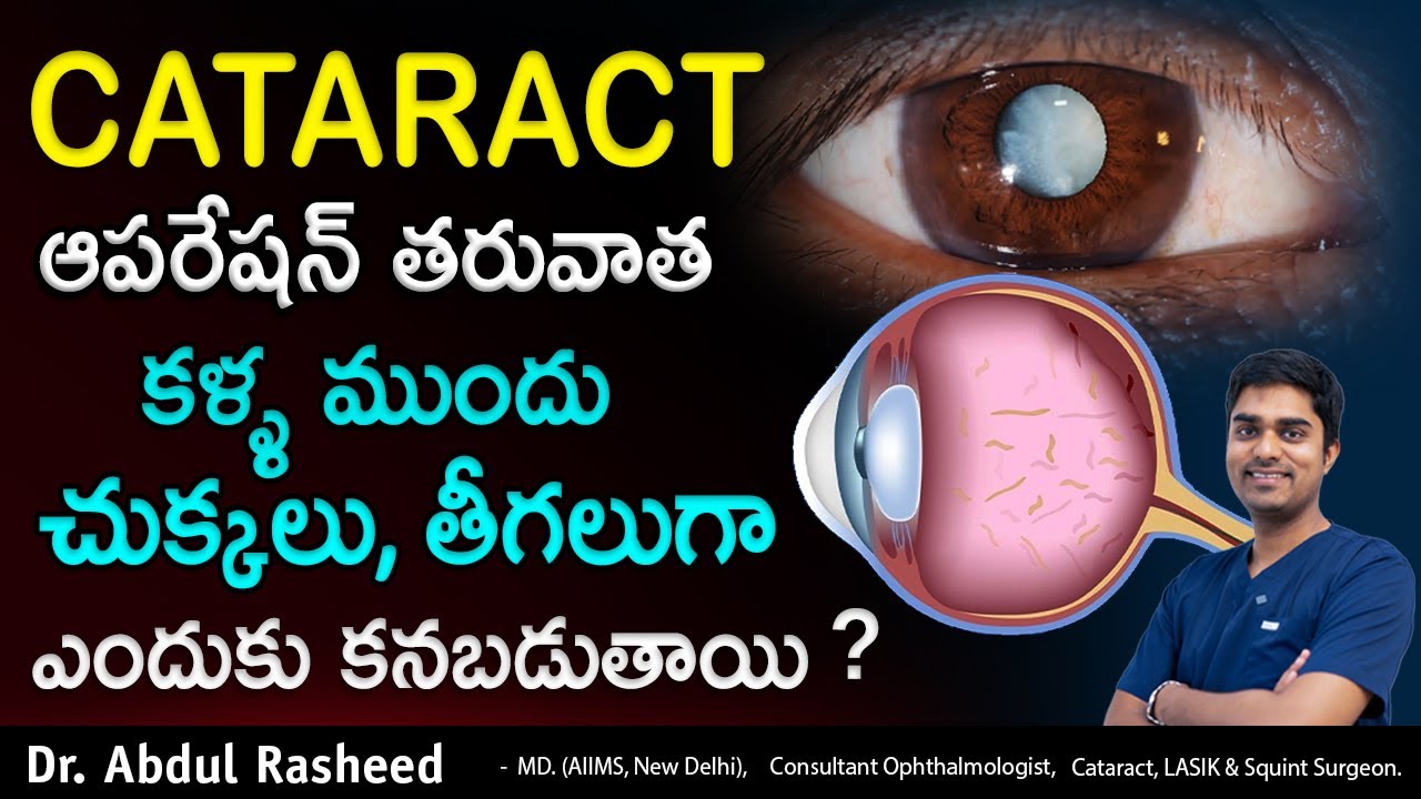 Floaters After Cataract Surgery In Telugu Cataract Surgery Telugu floaters-after-cataract-surgery-in-telugu-cataract-surgery-telugu