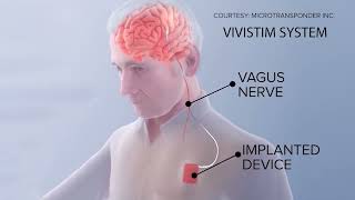 REWIRING RECOVERY: VIVISTIM FOR STROKE SURVIVORS