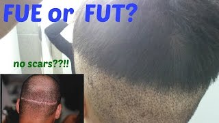 Fue Vs Fut? Which Hair Transplant Method Is Better?