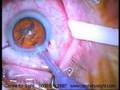 Youtube Thumbnail ACRILISA Multifocal Lens Implant