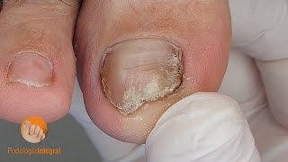 Nail psoriasis and onycholysis | Nail trimming and cleaning of the grooves [Podología Integral]