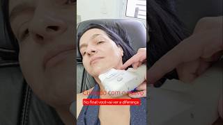 Ultrassom microfocado na Clínica Ruman, efeito lifting garantindo com sucesso e segurança.