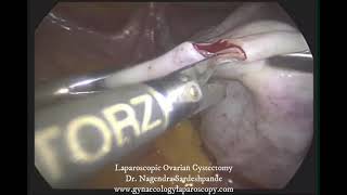 Laparoscopic ovarian cystectomy