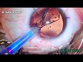 Best to learn ipcl eyepcl  toric implant   dr  kamal kapur