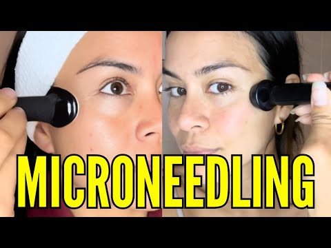 What Does Microneedling Actually Do? (10 Evidence-Based Benefits)