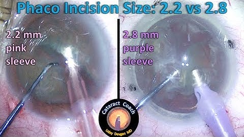 Phaco Incision Size: 2.2 mm vs 2.8 mm -- is smaller better for Cataract Surgery?