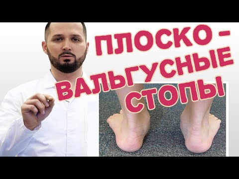 Плоско-вальгусная деформация стоп у детей