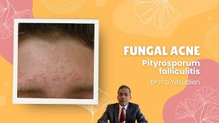 Pityrosporum Or Malezia Folliculitis Fungal Acne