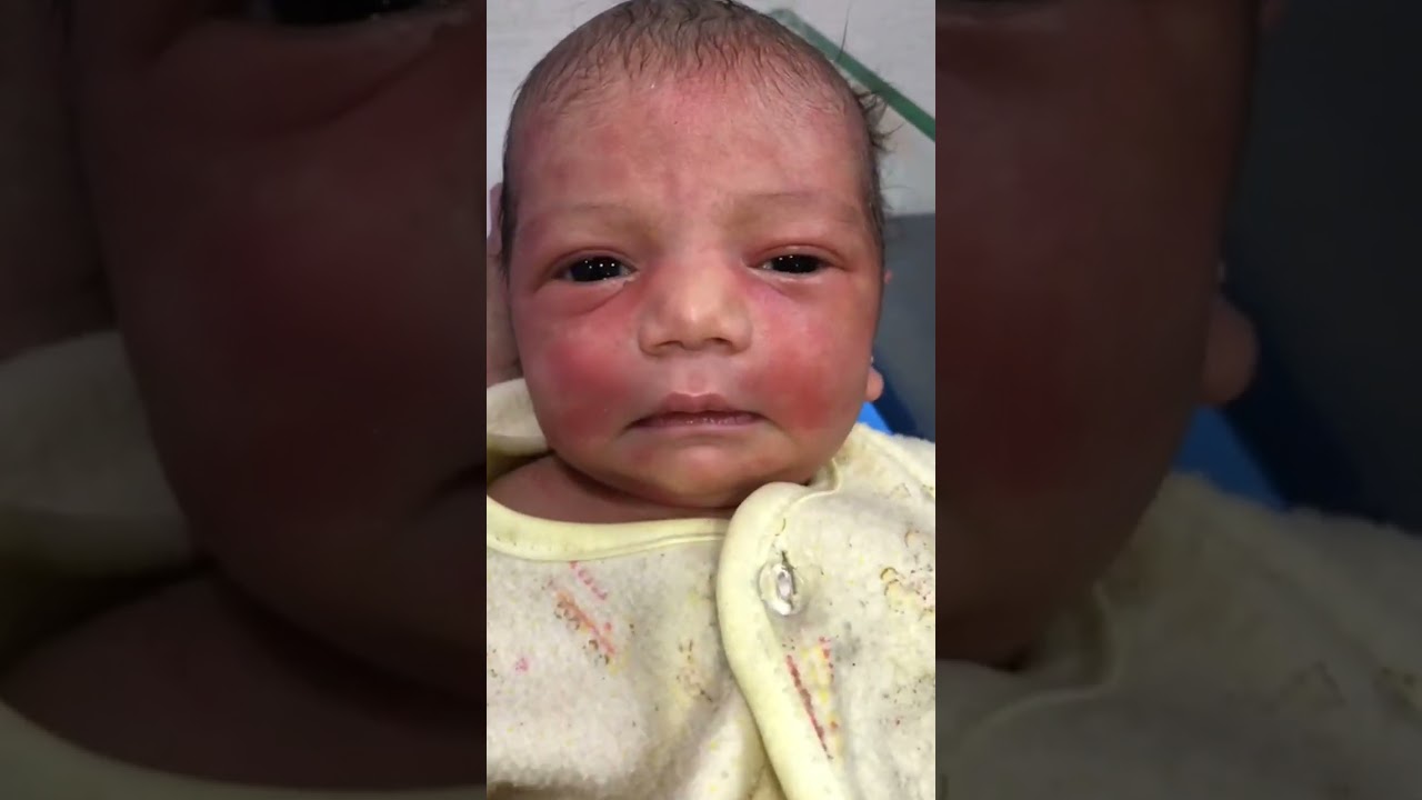 Newborn Baby in NICU with Gentle Red Face – Normal Newborn Rash Care 