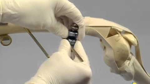 large external fixator in knee bridging moduler frame