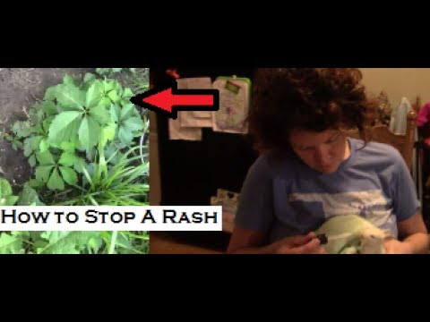 How to get rid of poison ivy rash FOREVER!!