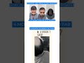 Update For a Grade 7 #HairTransplant Case By Dr. Gaurav